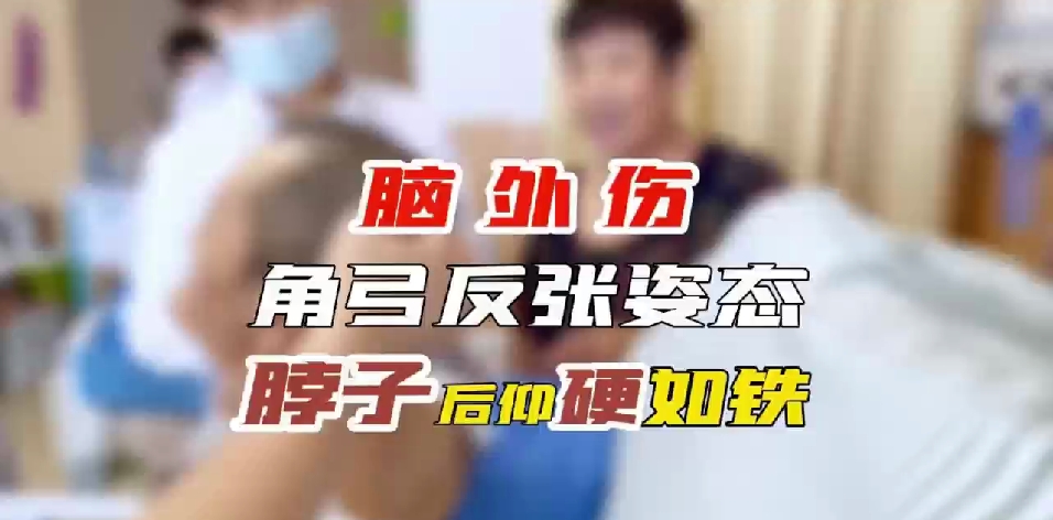 脑外伤  角弓反张姿态  脖子后仰硬如铣