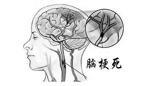 烟台脑梗的临床表现